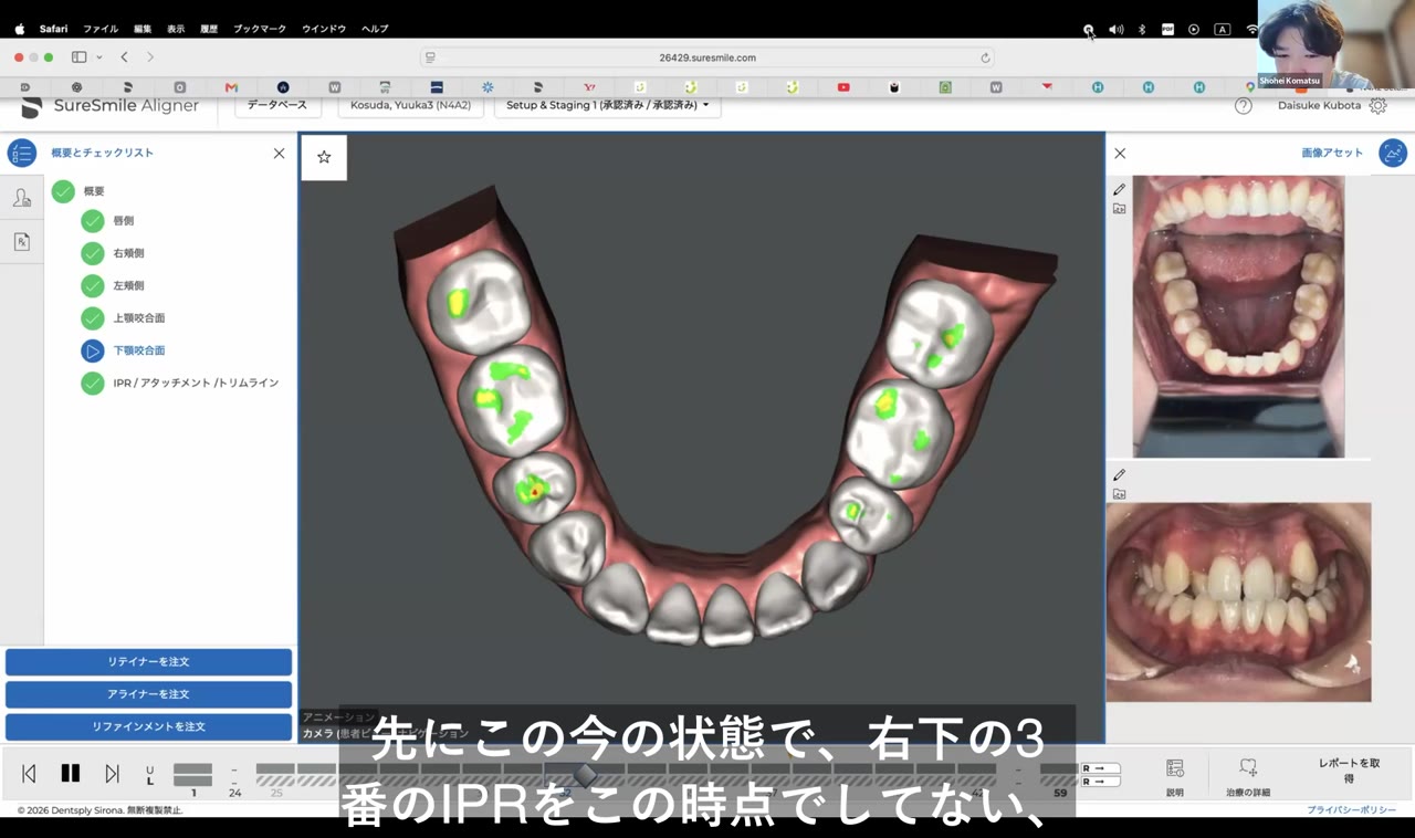 IPRのタイミングとレシオ