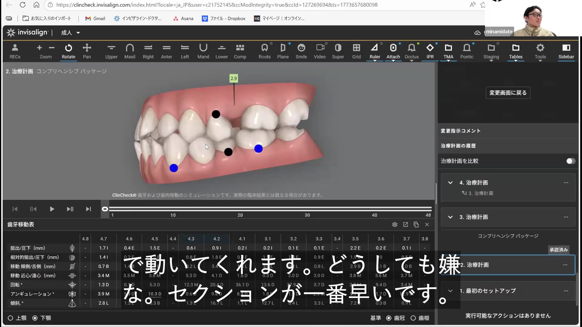 ボタンとパワーチェーンによる歯根移動の実例