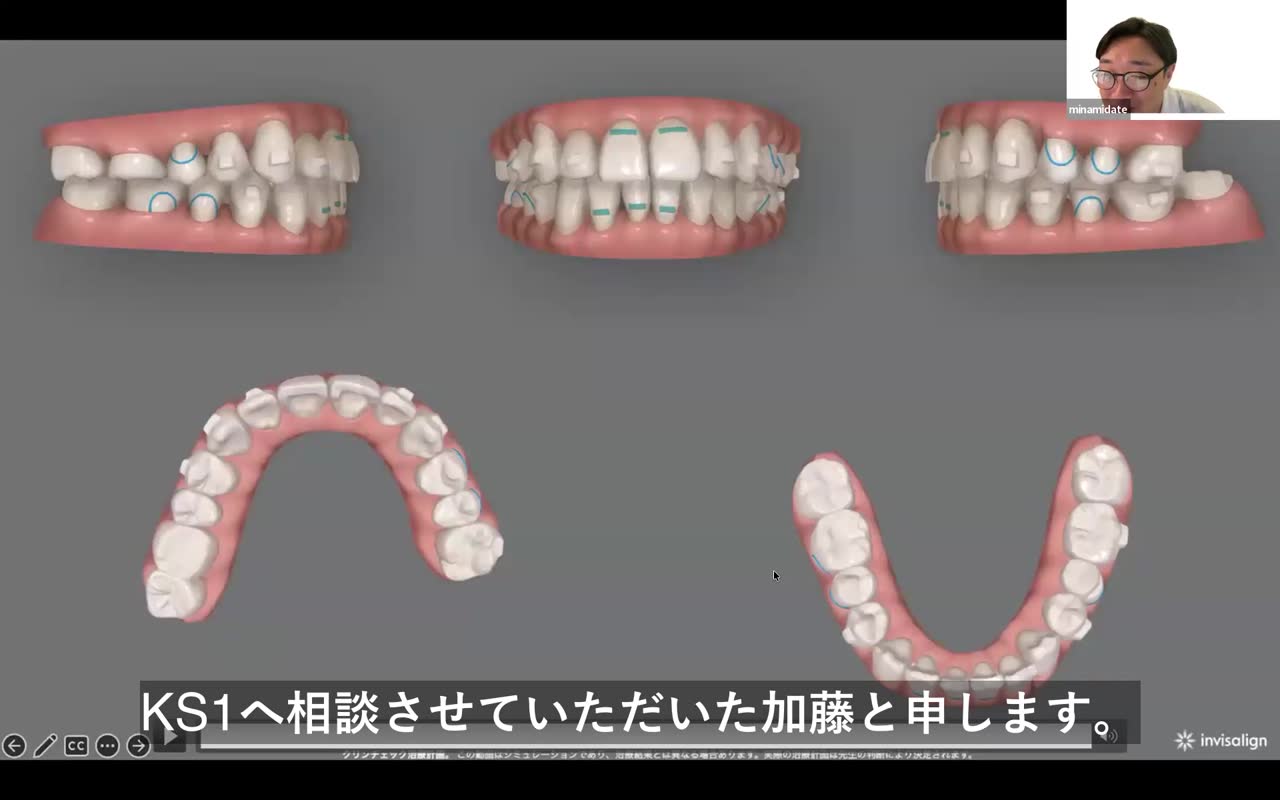 IPRとフレアリングの選択