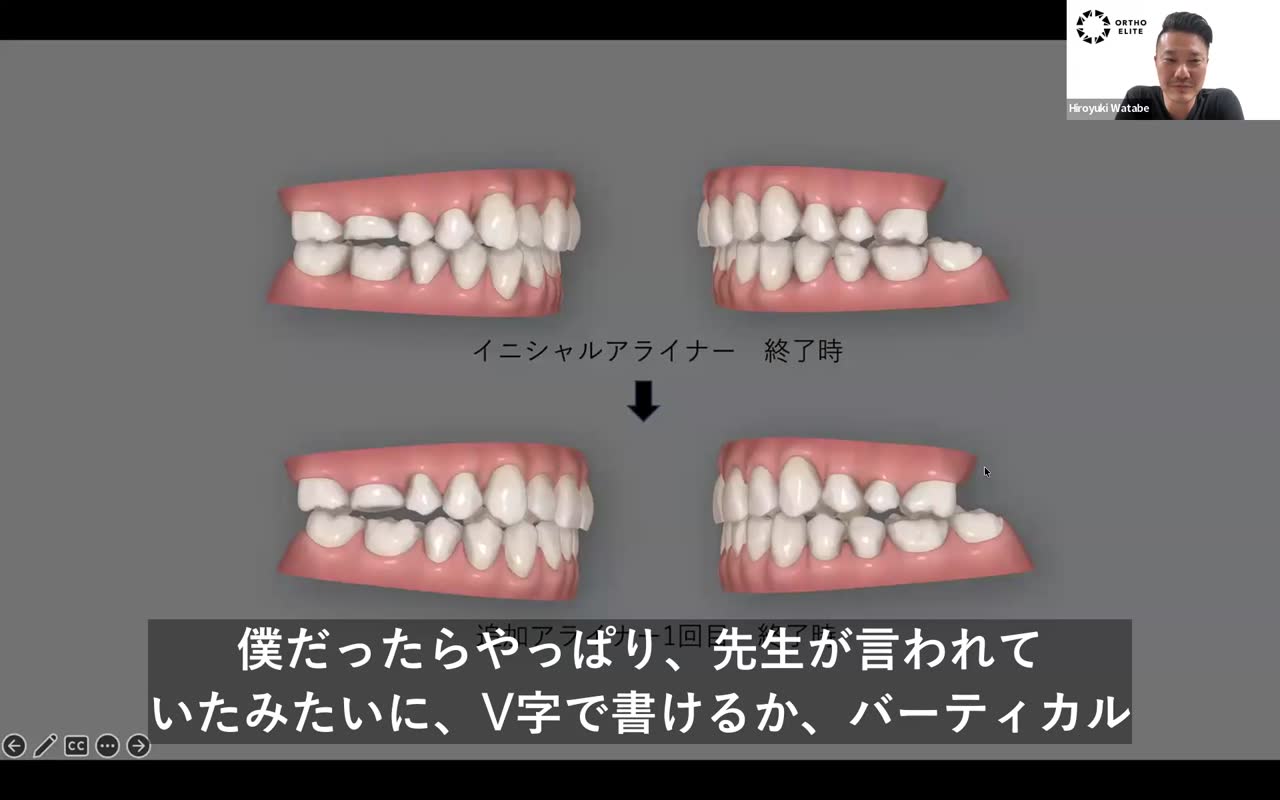 IPRとバイトランプの使い分け