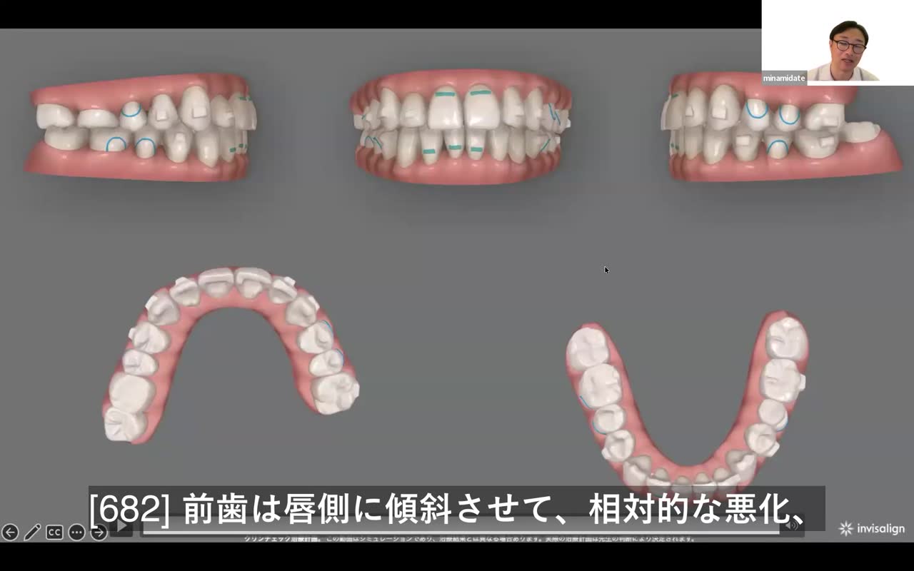 V字ゴムの効果と後戻り対策