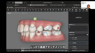 最適アタッチメントの落とし穴