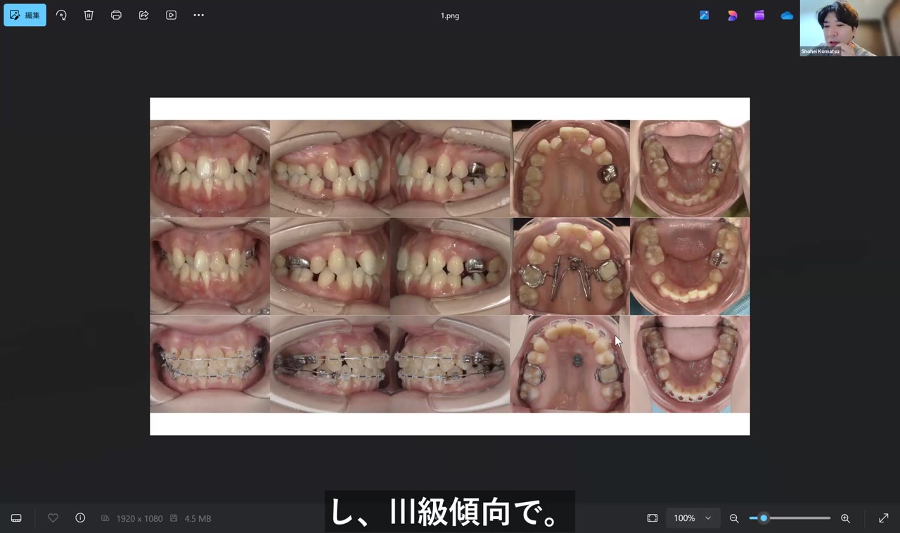難症例！スライダーとリセッション