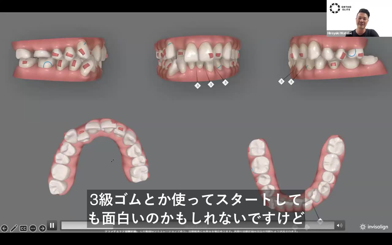 前歯移動のリスクと対策