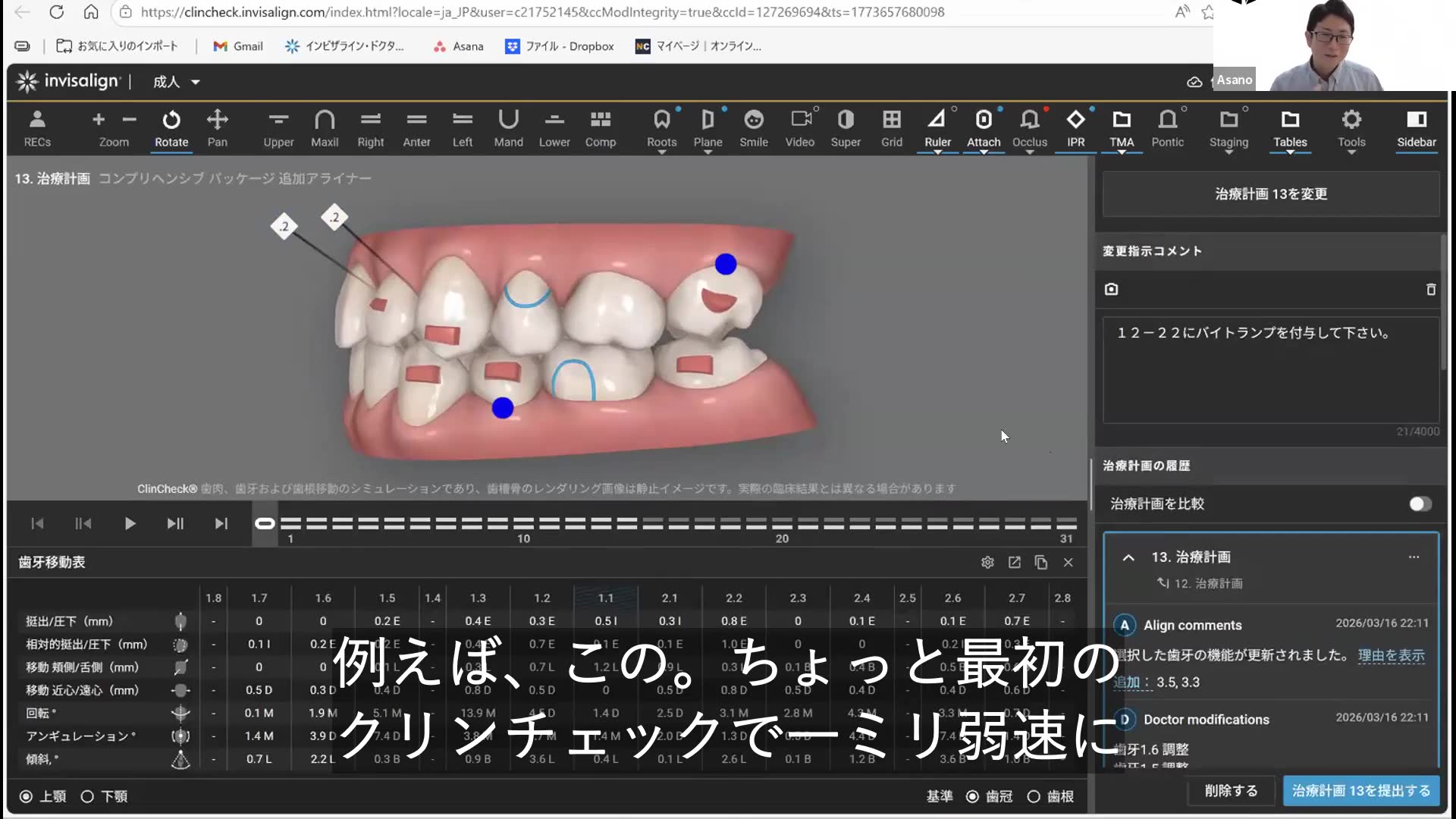ミッドラインの調整と臼歯のティップバック