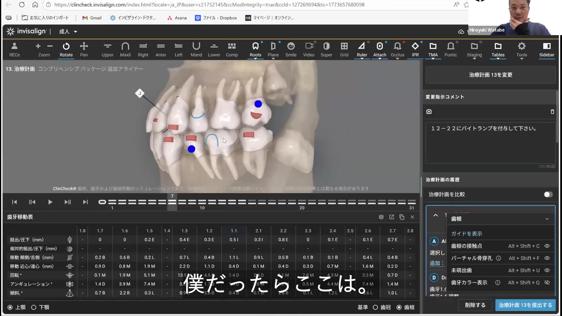 IPRの判断基準と抜歯の可能性