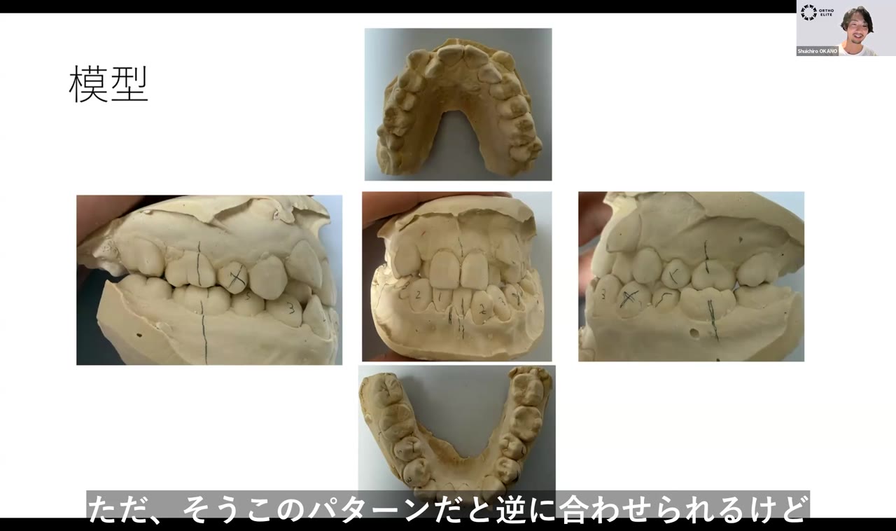 スリーインサイザーと診断の難しさ