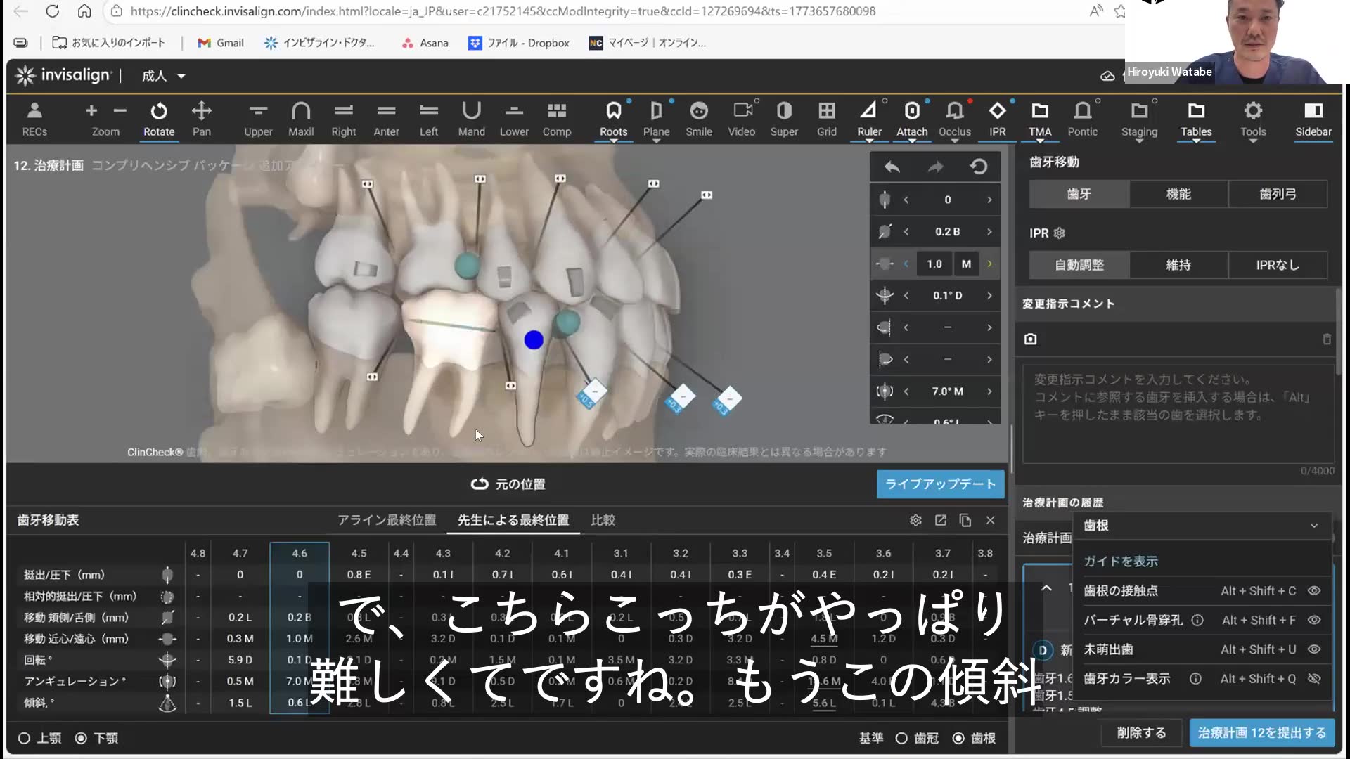 難易度の高い歯の傾斜に対するアタッチメントと反作用の利用
