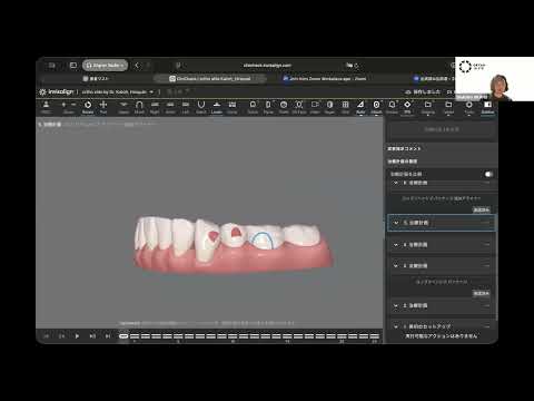 前歯悪化のアタッチメント