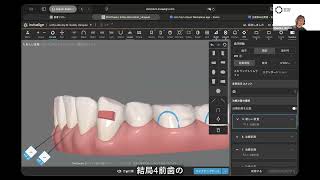 下顎3番の重要性