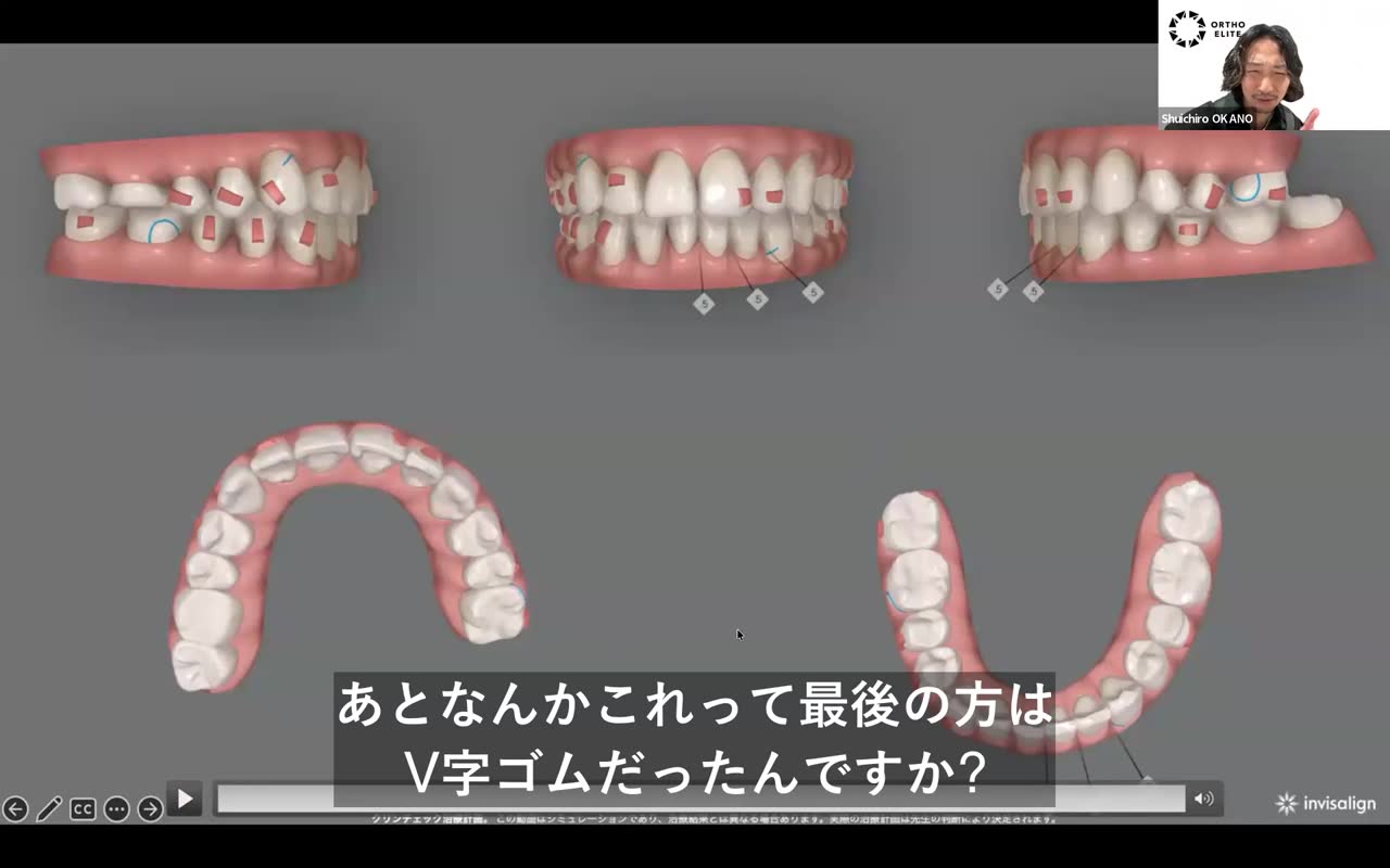 V字ゴムと前歯の咬合改善