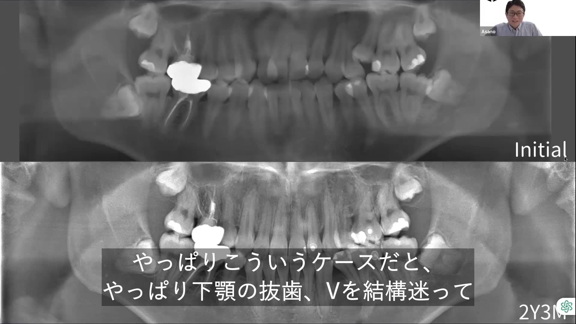 下顎の抜歯Vについて