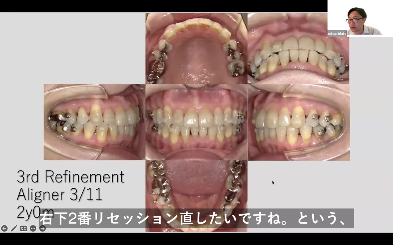 ミドルエイジ治療の難しさ
