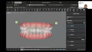 前歯の早期接触への対応
