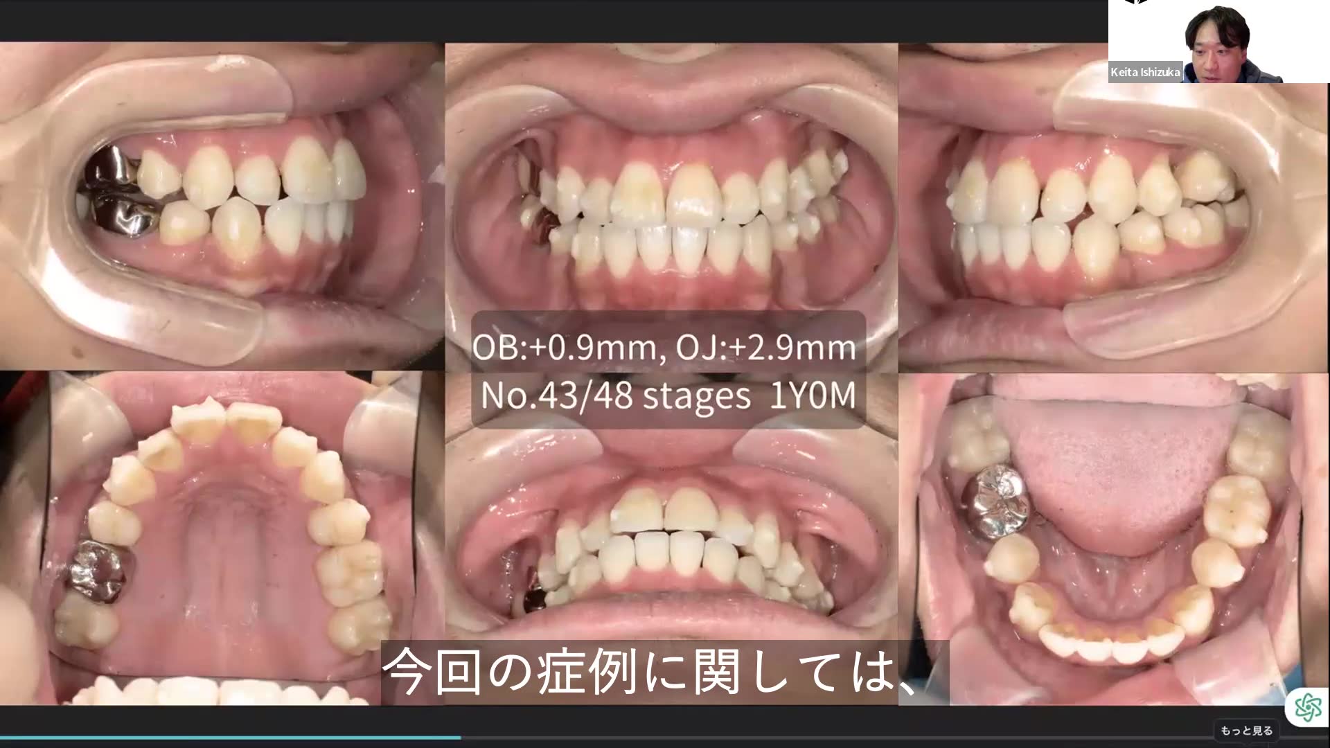 初回治療計画の反省点