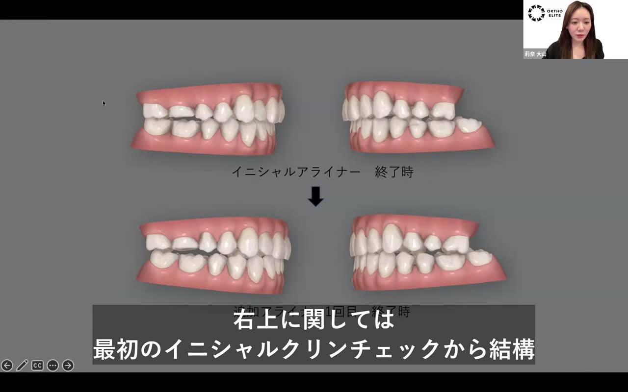 クリンチェックの落とし穴