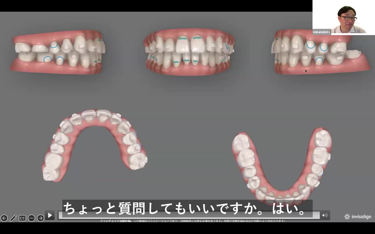 歯肉評価とブラックトライアングル